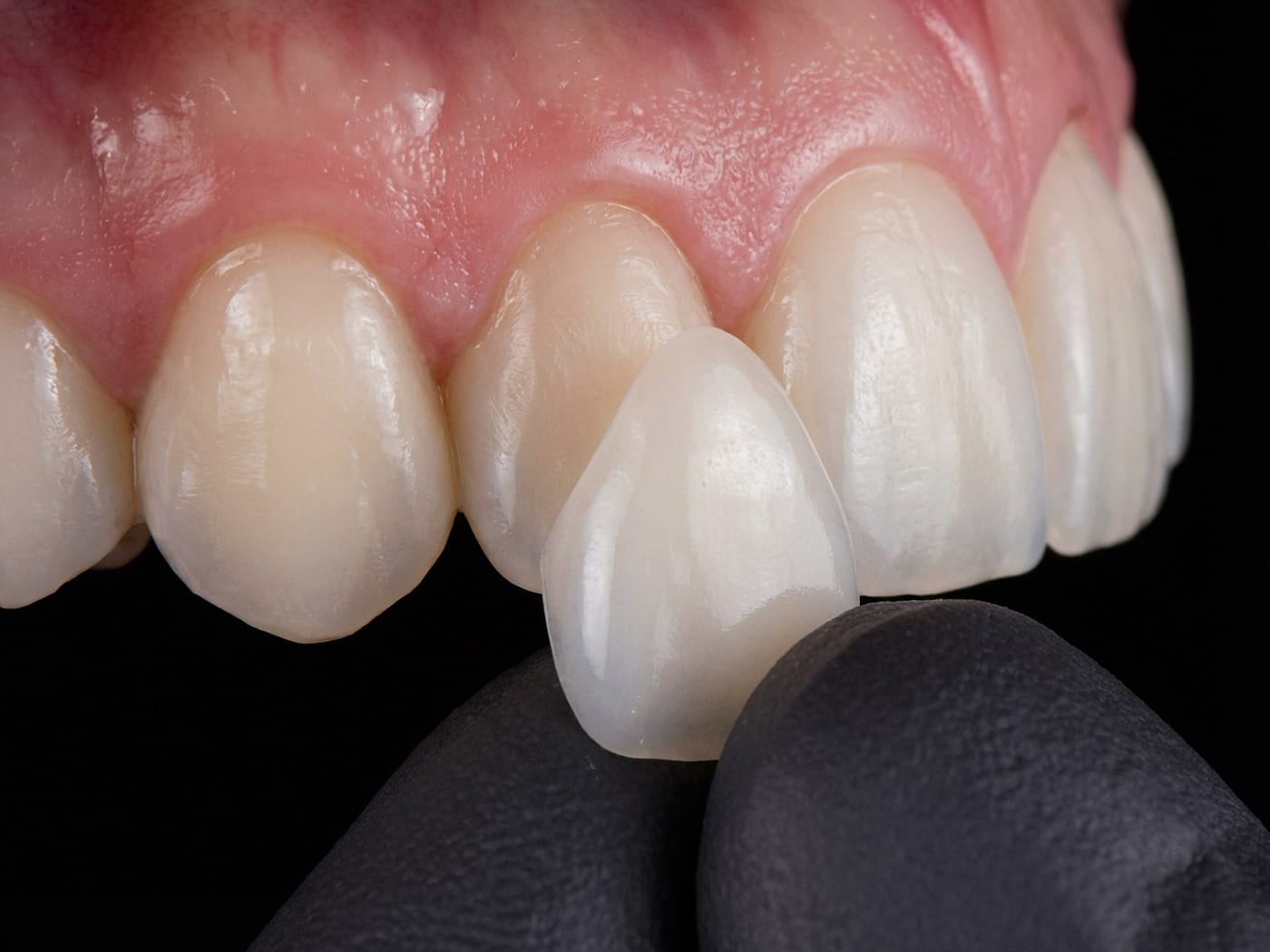 Handgeschichtete Veneers